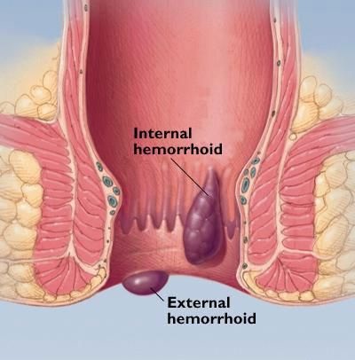 Hémorroïde homéopathie aromathérapie phytothérapie